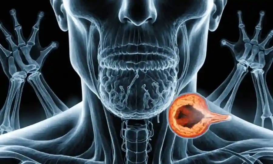 Radiografía de la cavidad nasal que muestra crecimiento fúngico, acompañado de ilustraciones de síntomas.